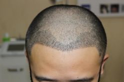 -大麦微针植发丨全国连锁