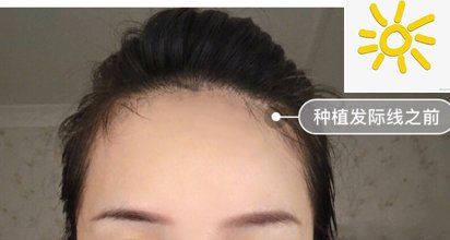 -大麦微针植发丨全国连锁