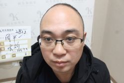 点击看大图 -大麦微针植发丨全国连锁