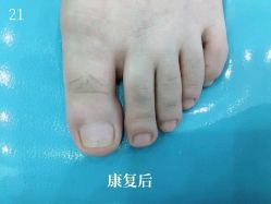 -德哥灰指甲脚气甲沟炎跖疣护理