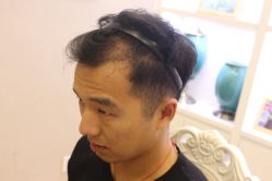 -大麦微针植发丨全国连锁