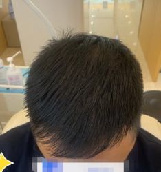 -大麦微针植发丨全国连锁