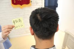 点击看大图 -大麦微针植发丨全国连锁