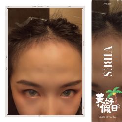 -大麦微针植发全国连锁