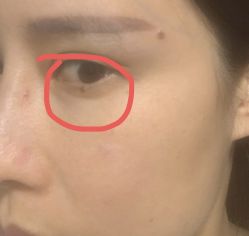 -南京健丽·去眼袋医疗美容机构