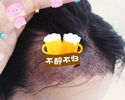 -大麦微针植发全国连锁