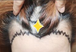 -大麦微针植发全国连锁