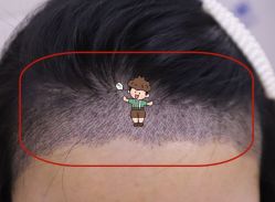 -大麦微针植发全国连锁