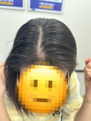 -大麦微针植发全国连锁