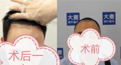 -大麦微针植发全国连锁