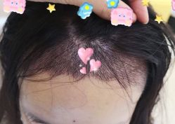 -大麦微针植发全国连锁