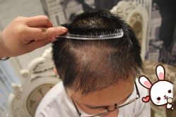 -大麦微针植发丨全国连锁