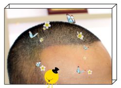 -大麦微针植发全国连锁