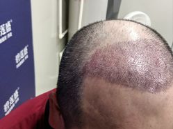 -碧莲盛·不剃发植发