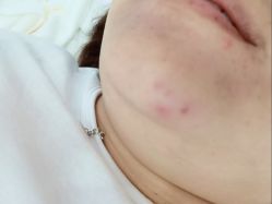 体验前-蕾特恩专业祛痘·皮肤管理