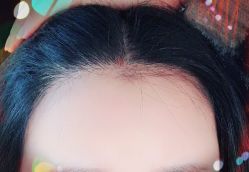 -大麦微针植发全国连锁