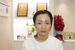 -大麦微针植发丨全国连锁