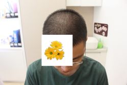 -大麦微针植发丨全国连锁