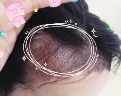 -大麦微针植发全国连锁