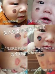 -美人痣全国连锁