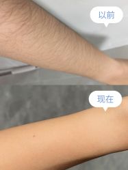 -薇兰专业脱毛连锁机构