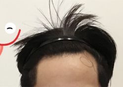 -大麦微针植发全国连锁