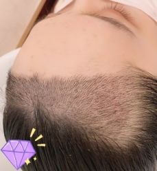 -大麦微针植发丨全国连锁