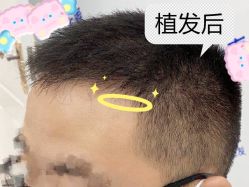 -大麦微针植发全国连锁