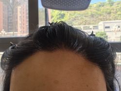 -碧莲盛·不剃发植发