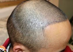 -大麦微针植发丨全国连锁