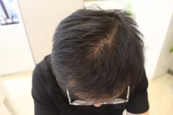 -大麦微针植发丨全国连锁