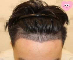 -大麦微针植发丨全国连锁