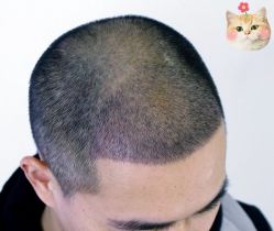 -大麦微针植发丨全国连锁