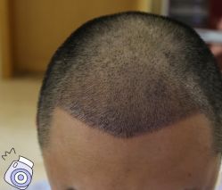 -大麦微针植发丨全国连锁