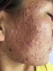 -苗方清颜专业祛痘连锁机构