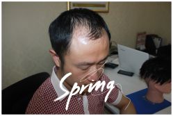 -大麦微针植发全国连锁