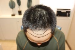 -大麦微针植发丨全国连锁