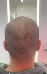 体验后-大麦微针植发全国连锁