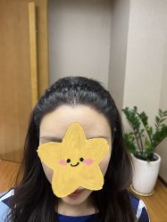 点击看大图 体验后-大麦微针植发全国连锁