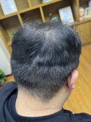 -大麦微针植发全国连锁