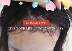 -大麦微针植发全国连锁