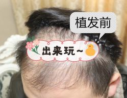 -大麦微针植发全国连锁