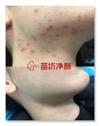 -苗坊净颜痘斑美容护肤连锁