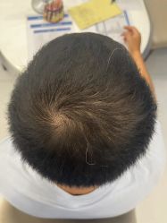 -大麦微针植发全国连锁