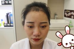 -大麦微针植发丨全国连锁