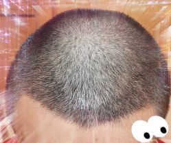 -大麦微针植发全国连锁