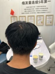 -大麦微针植发全国连锁