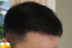 -大麦微针植发丨全国连锁