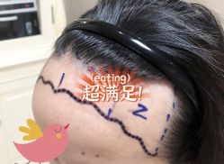 -大麦微针植发全国连锁