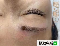 -美人痣全国连锁